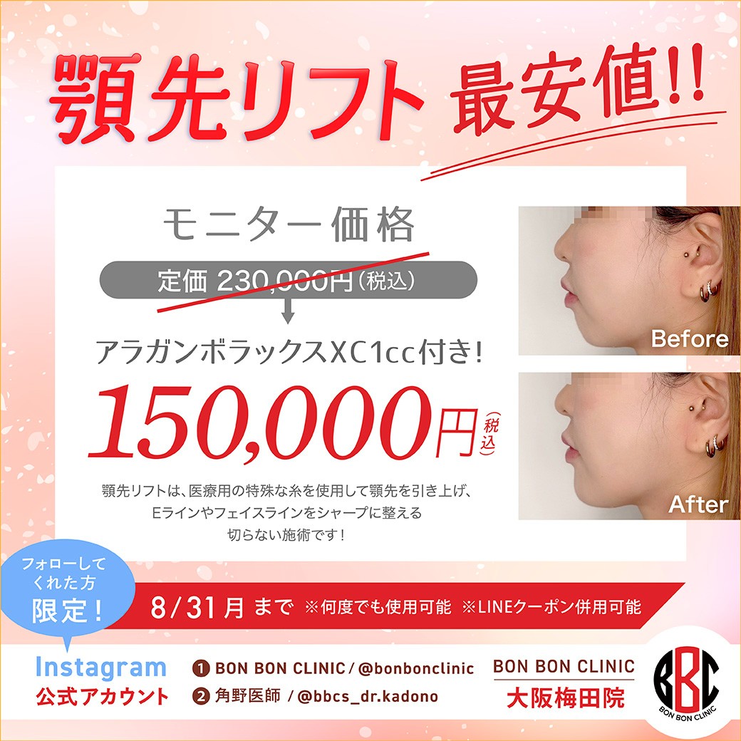 顎先リフトのクーポン画像