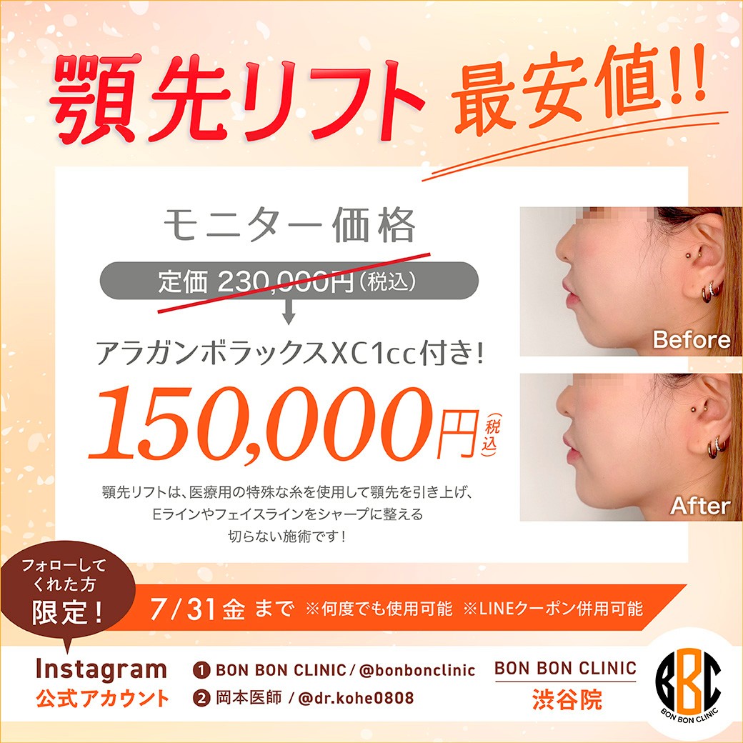 顎先リフトのクーポン画像