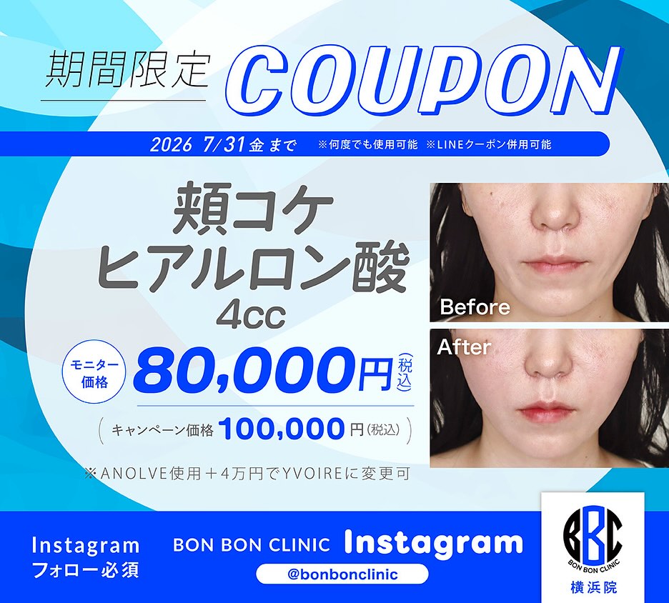 頬コケヒアルロン酸4ccのクーポン画像