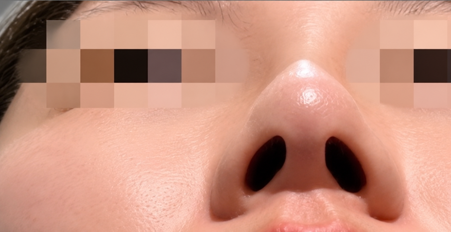 症例写真：ヒアルロン酸の施術後01