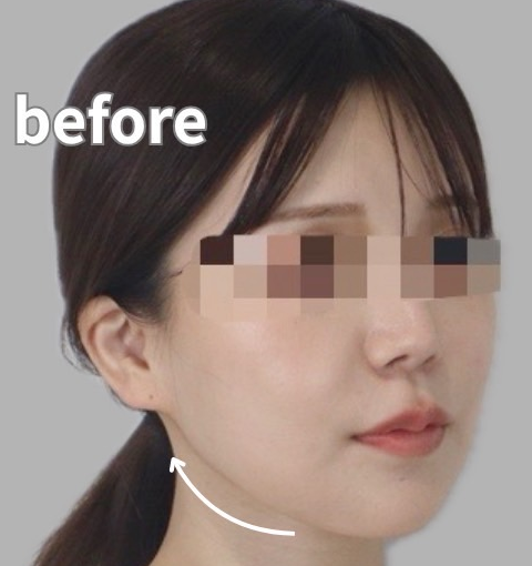 症例写真：糸リフトの施術前06