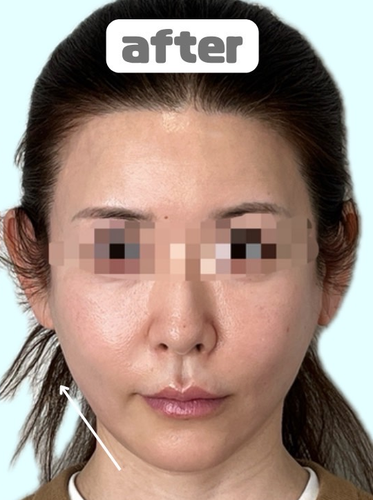 症例写真：糸リフトの施術後07