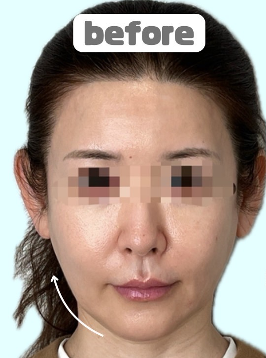 症例写真：糸リフトの施術前07