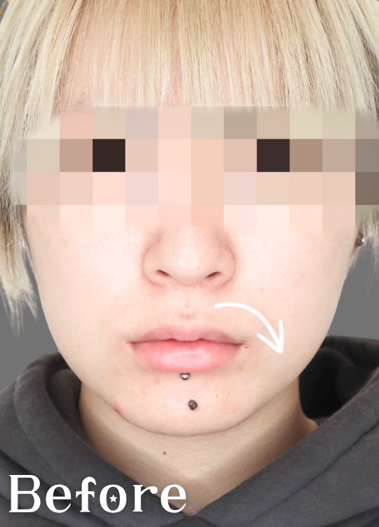 症例写真：口角挙上術の施術前