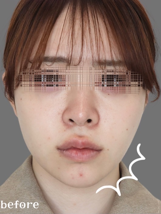 症例写真：糸リフトの施術前03