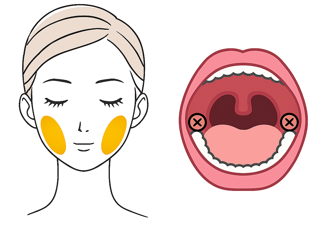バッカルファット除去(プレミアム)(BUCCAL FAT REMOVAL) バッカルファット除去(プレミアム)のイメージ図