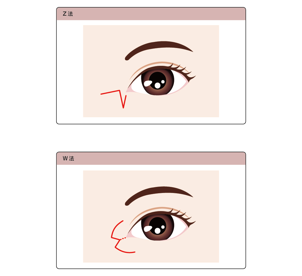 目頭切開ならボンボンクリニック 銀座駅前本院・渋谷院